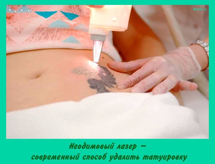 Неодимовый лазер
