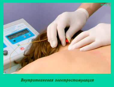 Внутритканевая электростимуляция