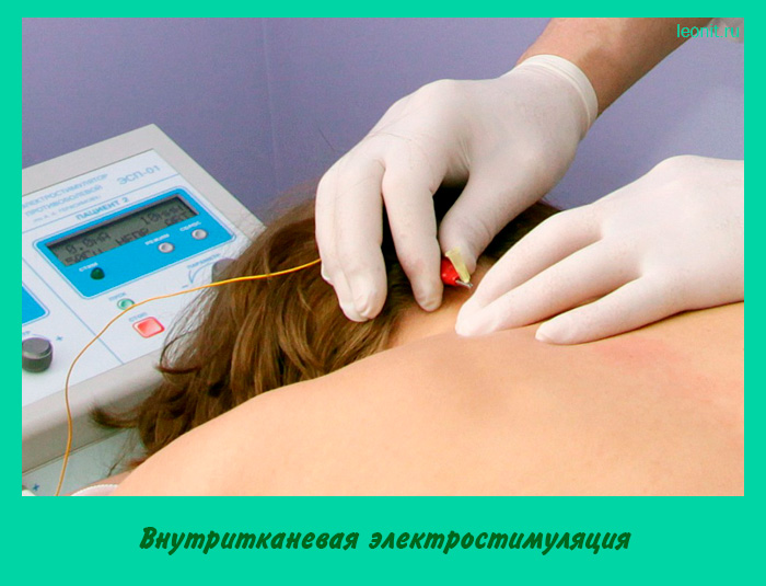Внутритканевая электростимуляция