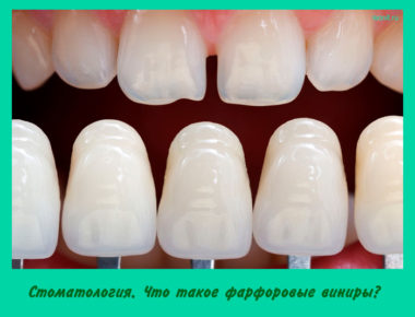 фарфоровые виниры