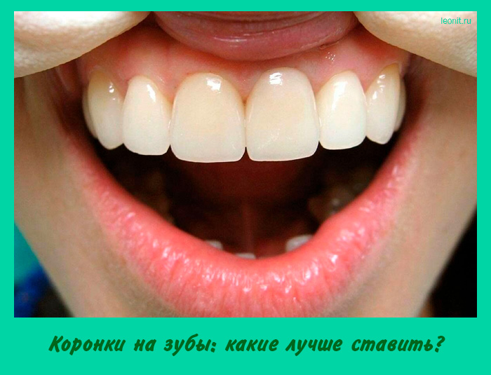 Коронки на зубы: какие лучше ставить?